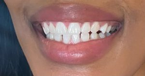 Refresche |  Teeth Whitening for 1