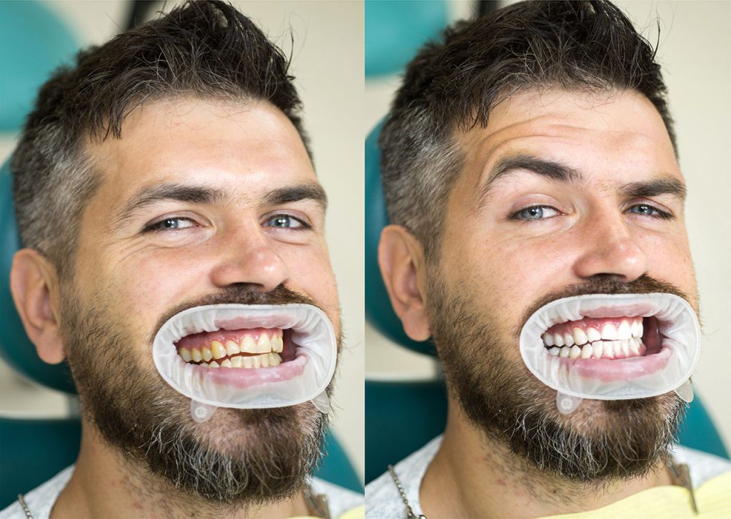 Teeth-Whitening-Before-After