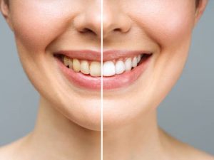 Medtech Wellness Spa | A Special Teeth Whitening Treatment for that Special Smile