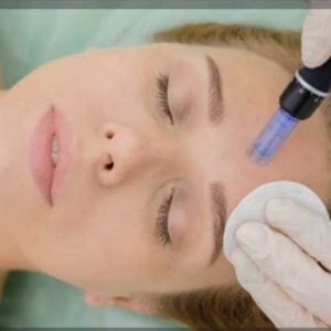 Nurture YourSelf | 60-Minute Face Microneedling for 1  At The Radisson Gautrain Blu Hotel