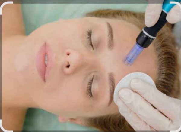 Nurture YourSelf | 60-Minute Face Microneedling for 1  At The Radisson Gautrain Blu Hotel