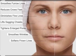 Nurture YourSelf | 60-Minute Face Microneedling for 1  At The Radisson Gautrain Blu Hotel