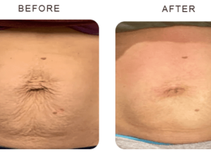 K Beauty Spa | 1 Session of Venus Freeze Abdomen Body Contouring For 1