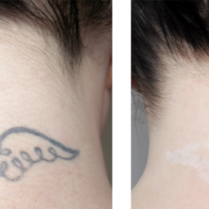 Blush Aesthetics and Beauty Bar | 4 Sessions of Picosecond Laser Tattoo Removal